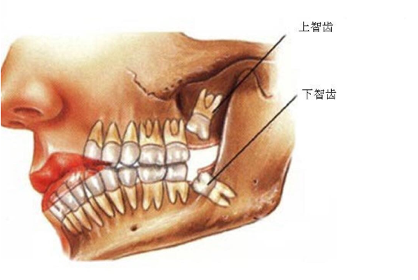 拔智齿后那个洞臭到恶心：可能是干槽症(需前往医院就医)