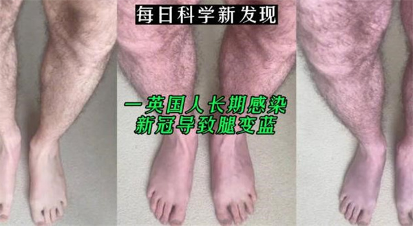 一英国人长期感染新冠导致腿变蓝