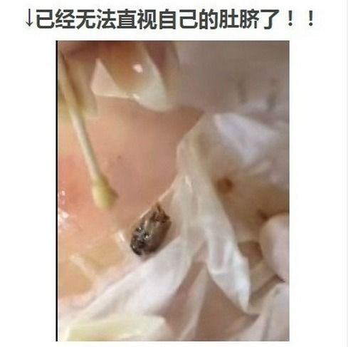 哦吼！医生提醒洗澡时不要清理肚脐眼