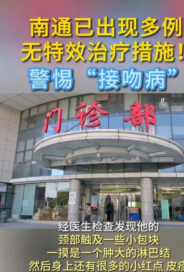 江苏南通已出现多例“接吻病”  接吻病是什么病严重吗？是什么原因造成的？