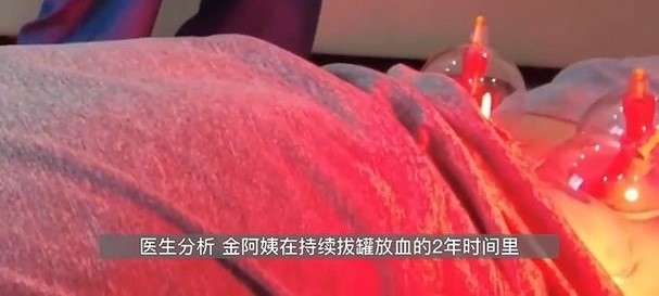 女子每周拔罐放血200ml致重度贫血