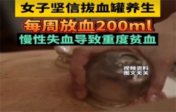女子每周拔罐放血200ml致重度贫血
