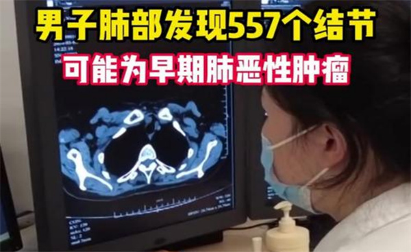 37岁男子肺部发现557个结节