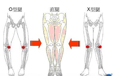 5种走路姿势会让你变成O型腿