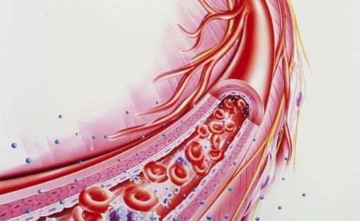 七类人重点防血栓 冲走血栓防住六成血管病