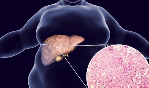 脂肪肝是把软刀子 即使不胖肝脏可能早已被脂肪包围