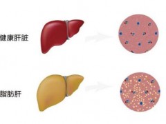 脂肪肝的治疗方法 应酬男应该看看