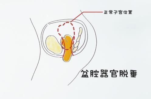 得了盆腔脏器脱垂怎么办？盆腔脏器脱垂患者如何护理