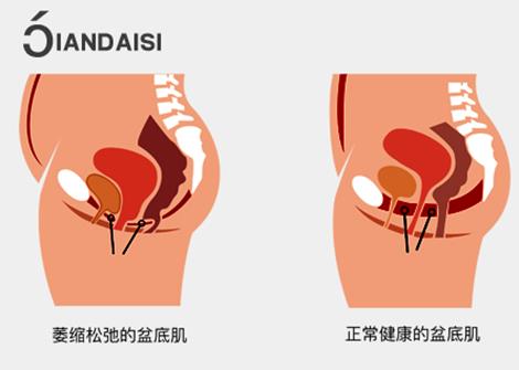 缩阴产品可以改善漏尿吗？疗效怎么样谁用谁知道