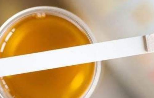 男性出现小便发黄的现象很危险 主要由2种原因造成
