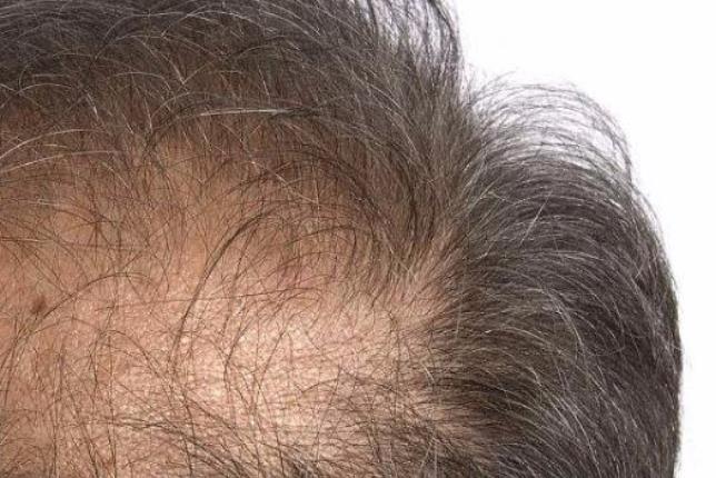 男人脱发危害大 当心影响家庭和谐