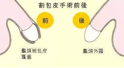 男人为什么要割包皮？割包皮前要注意事项 割包皮后注意事项