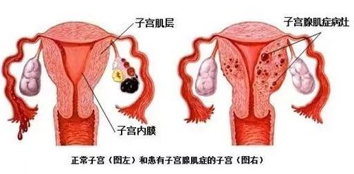 北京五洲妇儿医院妇科好吗？子宫腺肌症治疗方法？