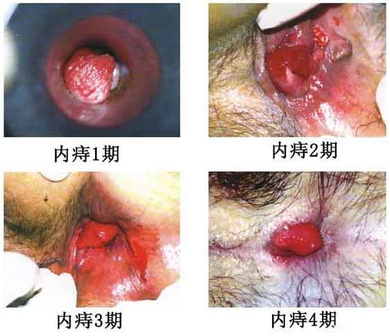 女性痔疮真人实拍图片 网上曝光的7个小偏方有效治痔疮