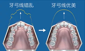 五洲妇儿医院口腔科：MRC矫治器让孩子咬着就能矫正牙齿的神器