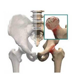 如何预防股骨头坏死？股骨头坏死的症状是什么