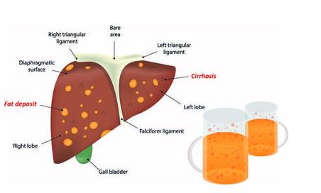 酒精性肝硬化是怎么回事？酒精性肝硬化可以治愈吗