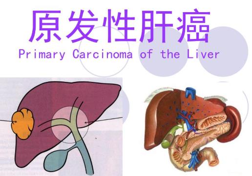 原发性肝癌不能吃什么？原发性肝癌的早期症状