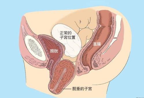 盆腔脏器脱垂的症状是什么？如何预防盆腔脏器脱垂