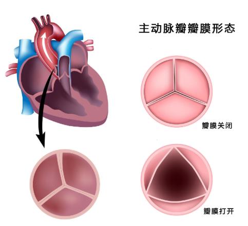 主动脉关闭不全严重吗？主动脉关闭不全是怎么引起的