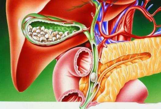 如何预防胆囊息肉？胆囊息肉的危害