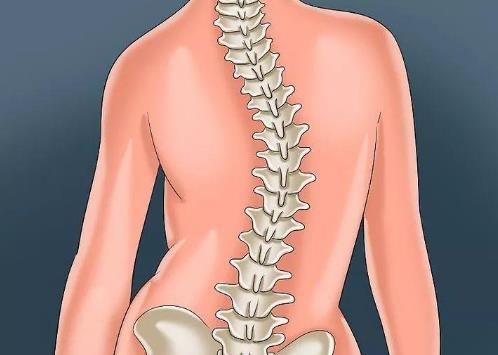 脊柱侧弯矫正器有用吗？脊柱侧弯的危害