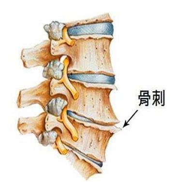 什么叫骨质增生？骨质增生要注意什么事项