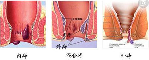 武汉马应龙肛肠医院：怎样对内痔进行鉴别