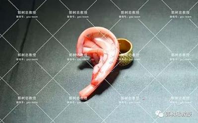 郭数忠：小耳症（五十）耳再造的条件究竟有哪些？