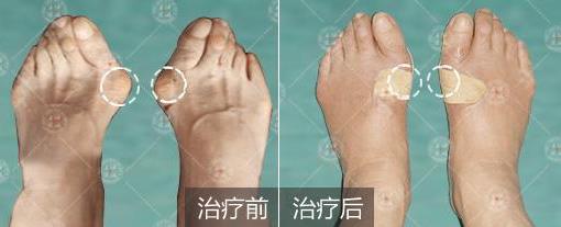 上海健桥医院治疗拇外翻（大脚骨）怎么样？百姓点评排行