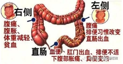 武汉东大肛肠医院：记得重视肠道检查