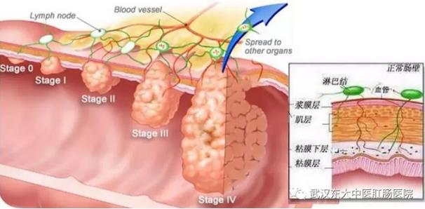 武汉东大肛肠医院：记得重视肠道检查