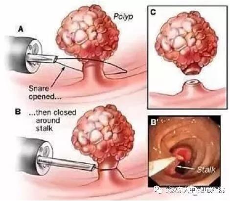 武汉东大肛肠医院：记得重视肠道检查