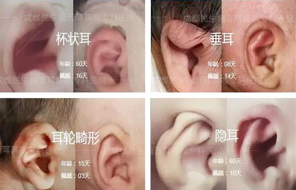 成都民生耳鼻喉医院好不好 先天性耳畸形的原因 打造品牌医院