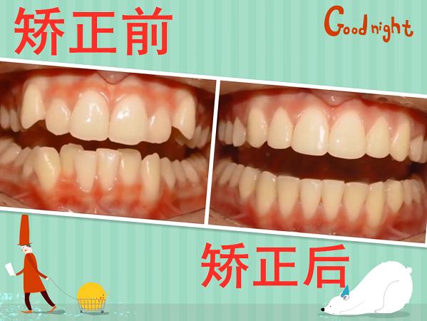 在昆明牙齿不齐怎么快速矫正？