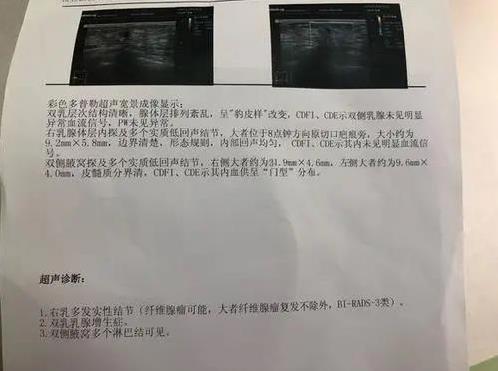 【一位女性自述】我和乳腺疾病抗争的日子 如何重获健康人生