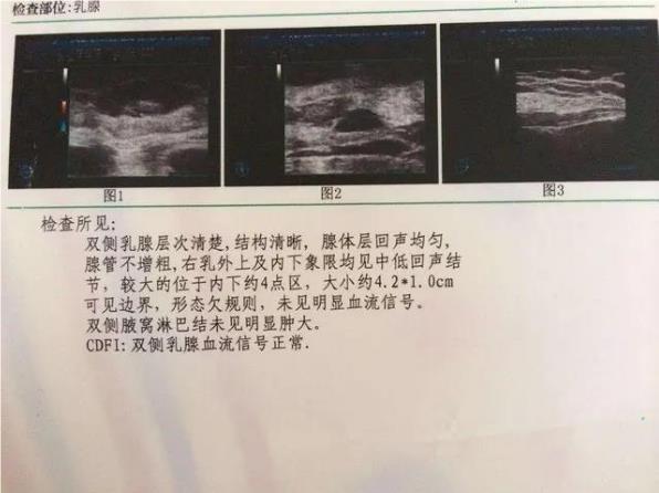 【一位女性自述】我和乳腺疾病抗争的日子 如何重获健康人生