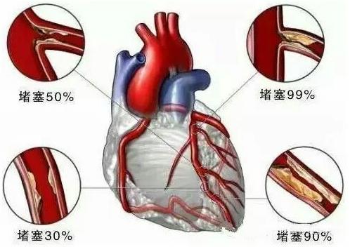 杭州怡养医院发声：年轻人，你离心脑血管疾病没多远！