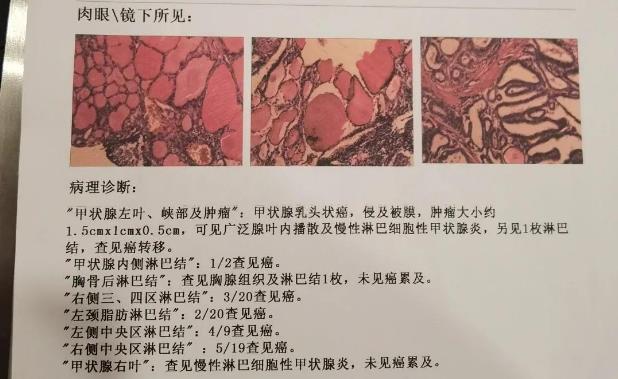 甲状腺癌到底和遗传有没有关系？听听成都民生耳鼻喉专家怎么说