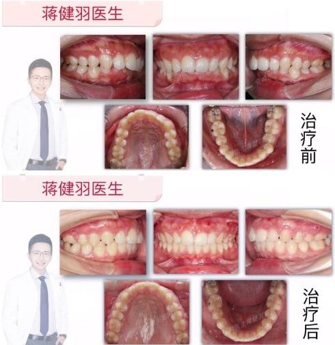 潜心学术，厚积薄发---推动中国隐形正畸创新的领头羊是谁