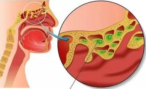 鼻窦炎真难受！成都民生耳鼻喉医院叫你快来看看怎么办！