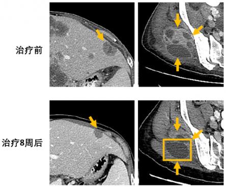 两个月咳出肿瘤组织，高响应率非小细胞肺癌靶向药将改变患者命运