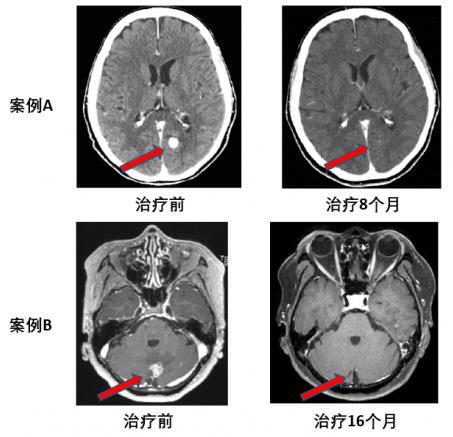 两个月咳出肿瘤组织，高响应率非小细胞肺癌靶向药将改变患者命运