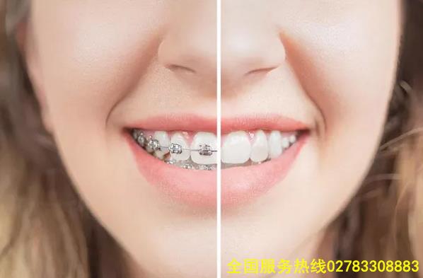 昆明牙齿矫正费用是多少？德韩口腔揭秘影响价格因素