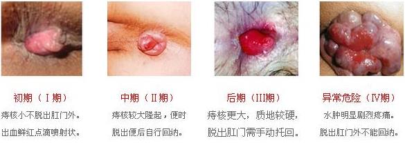 深圳天元中医肛肠医院：自测你的痔疮发展到什么程度了