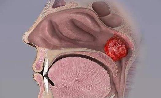 引起腺样体肥大的原因有哪些？腺样体肥大有哪些症状？