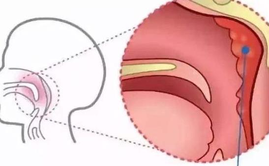 哪些人易患腺样体肥大？腺样体肥大有哪些并发症？