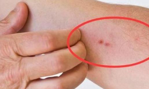 胆道出血有哪些症状？胆道出血的原因有哪些？
