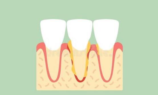 哪些人易患牙周病？为什么会患牙周病？