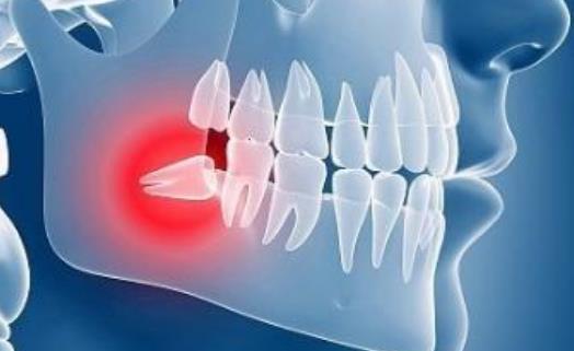 什么是智齿冠周炎？智齿冠周炎有哪些症状？